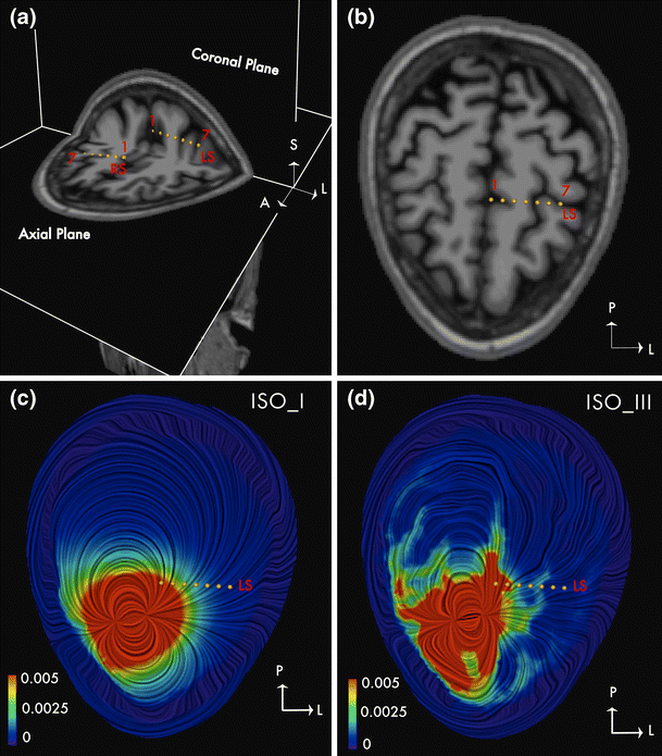 Experimental validation of the influence of white matter anisotropy on the intracranial EEG forward solution