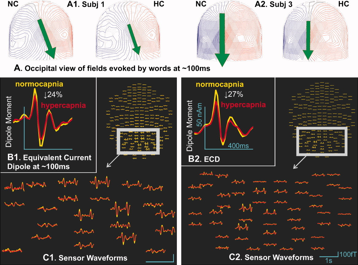 Depression of cortical activity in humans by mild hypercapnia — teaser figure