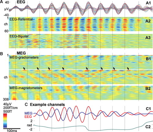 Magnetoencephalography Demonstrates Multiple Asynchronous Generators During Human Sleep Spindles