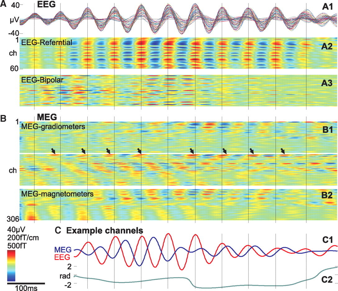 Magnetoencephalography Demonstrates Multiple Asynchronous Generators During Human Sleep Spindles